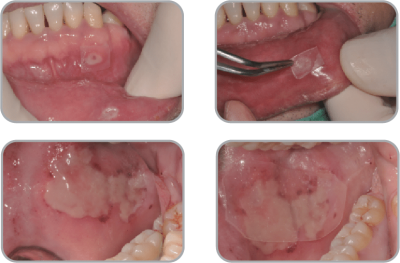New-Ora-Aid-minimax-implant-clinical_case2