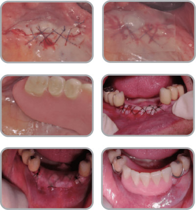 New-Ora-Aid-minimax-implant-clinical_case32