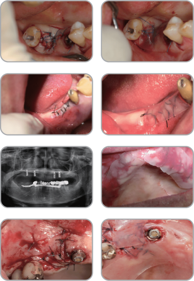 New-Ora-Aid-minimax-implant-clinical_case411