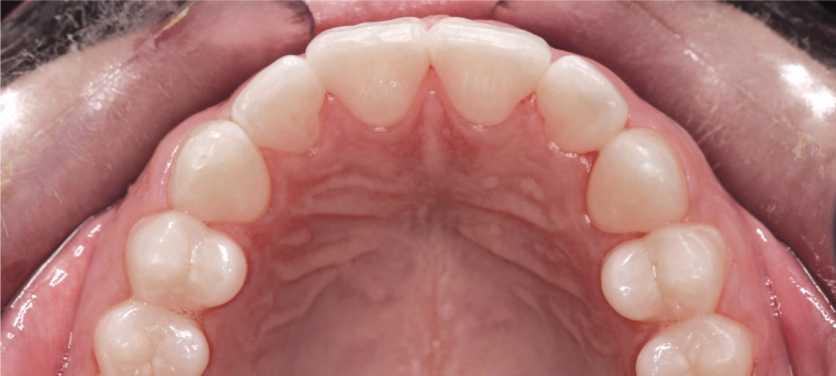 minimax medit clearcorrect