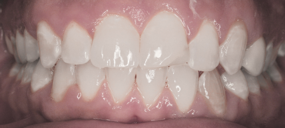 minimax medit clearcorrect