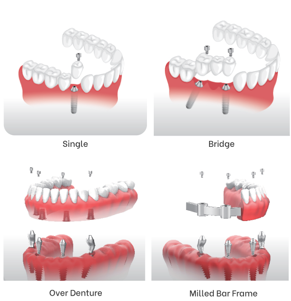 Maxfit-(Custom-Abutment)-11