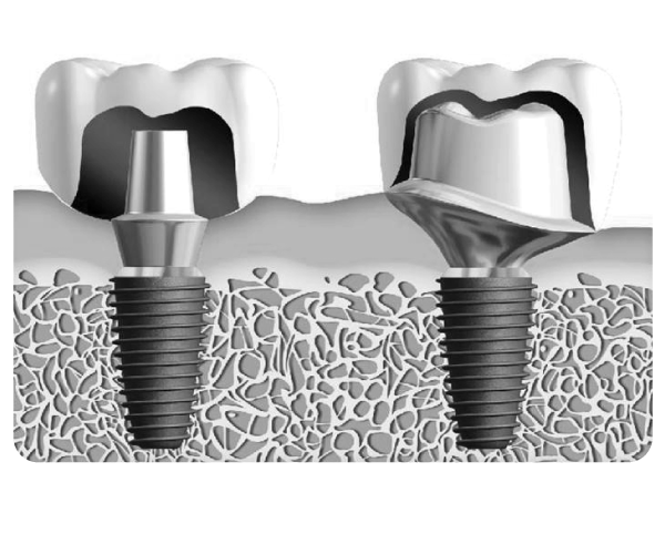 Maxfit (Custom Abutment)-2