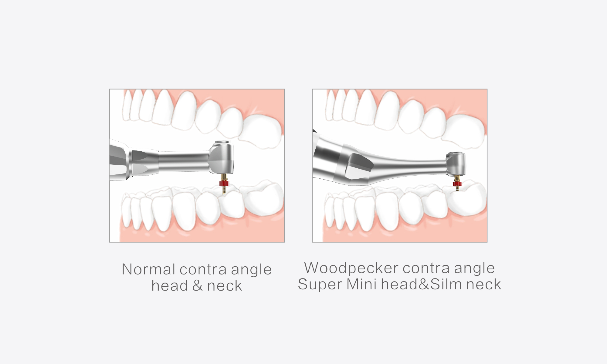 Woodpecker-Endo-Motor-MotoPex-Minimax-Implant-05-1.webp