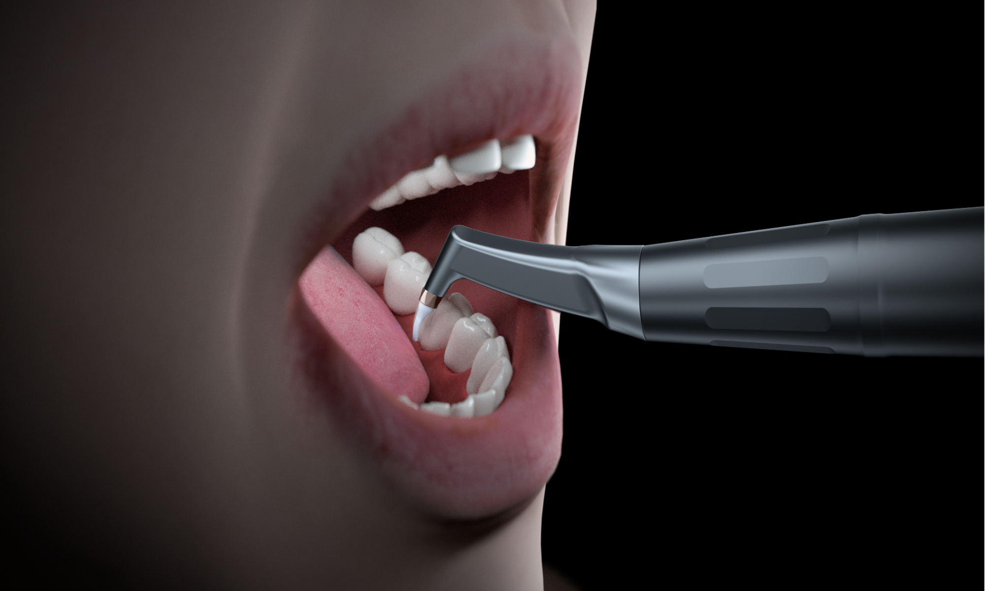 Minimax-Implant-Air-Polishing-System-Woodpecker-AP-H-Plus-11.webp