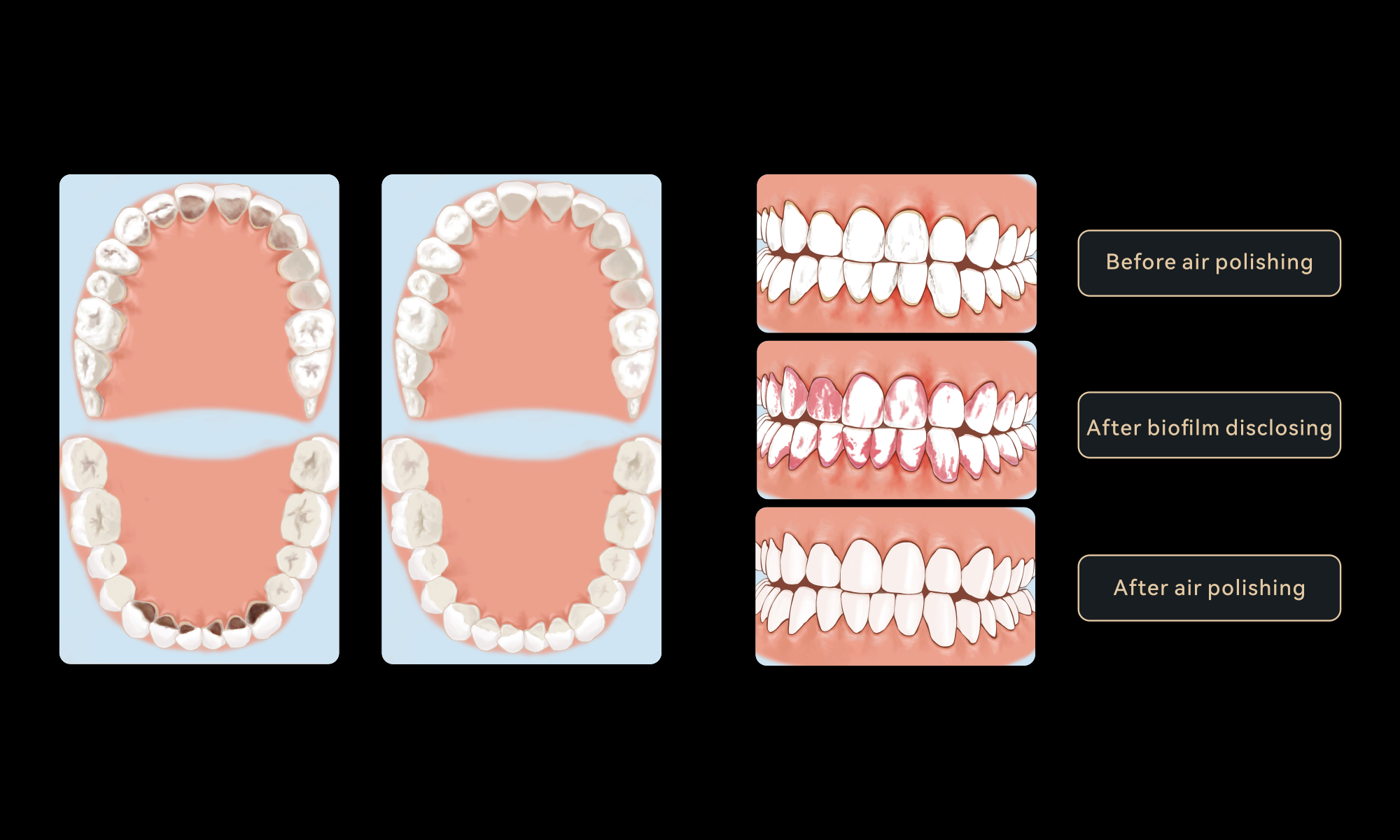 Minimax-Implant-Air-Polishing-System-Woodpecker-AP-H-Plus-12.webp
