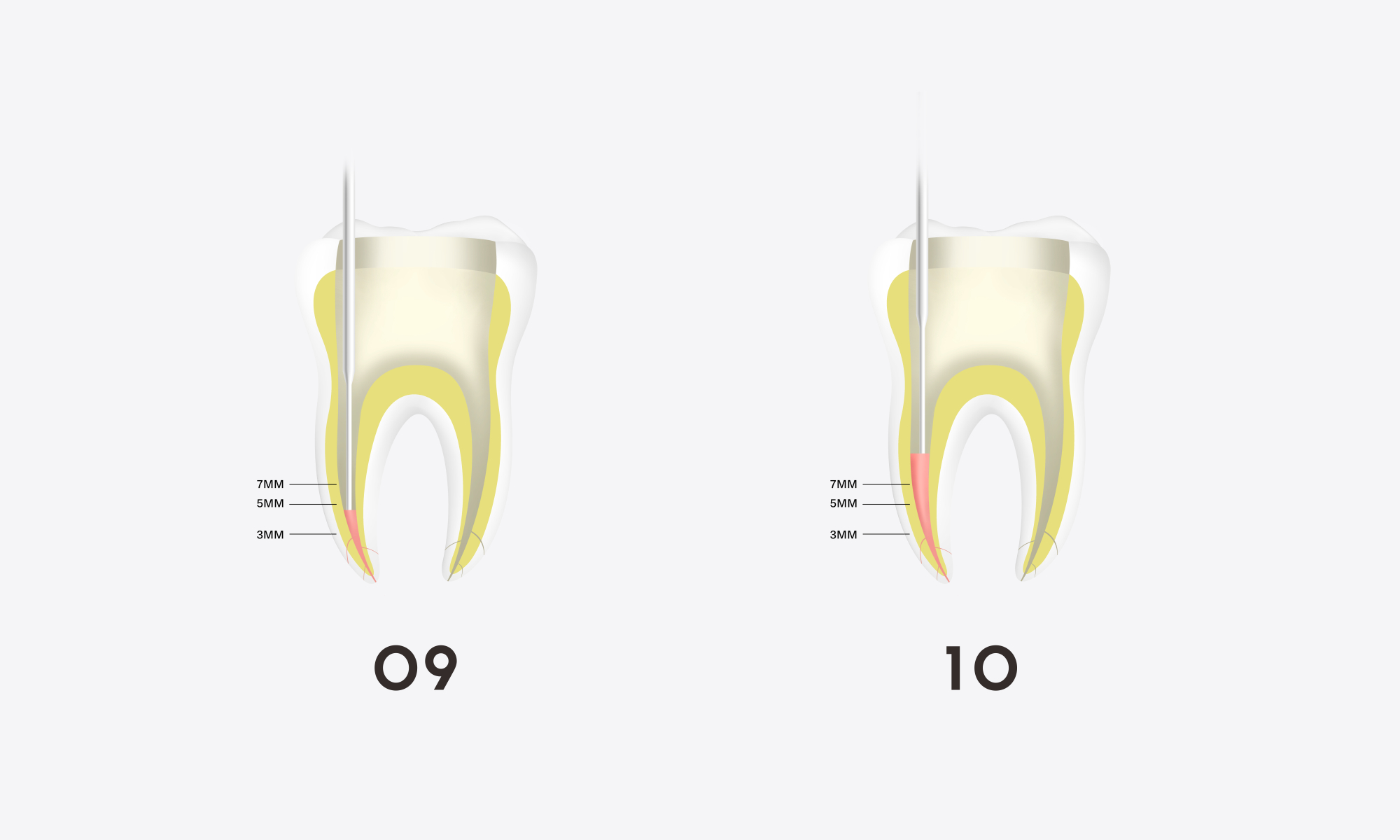 Minimax-Implant-Obturation-System-Woodpecker-Fi-G-Fi-P-07.webp