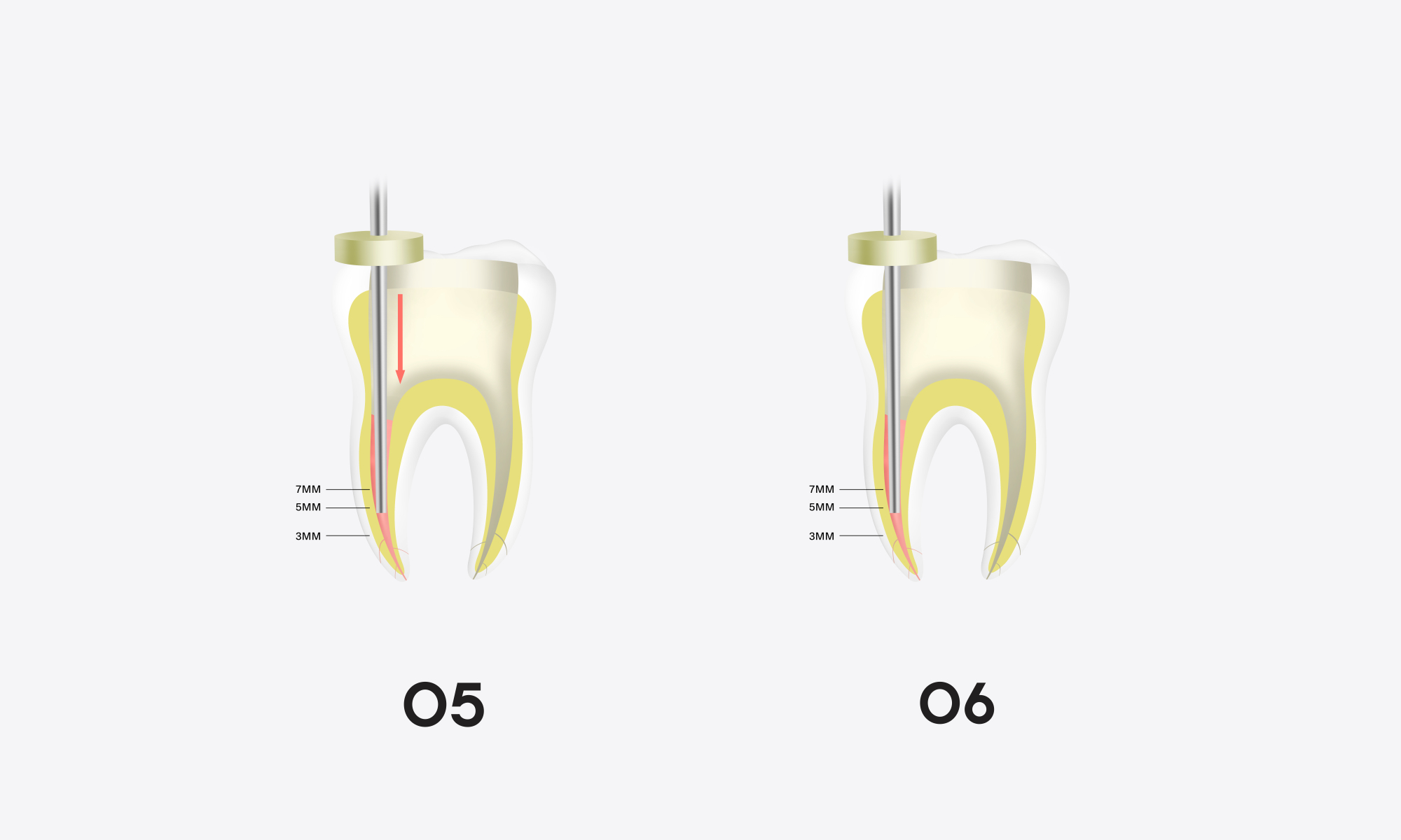 Minimax-Implant-Obturation-System-Woodpecker-Fi-G-Fi-P-08.webp
