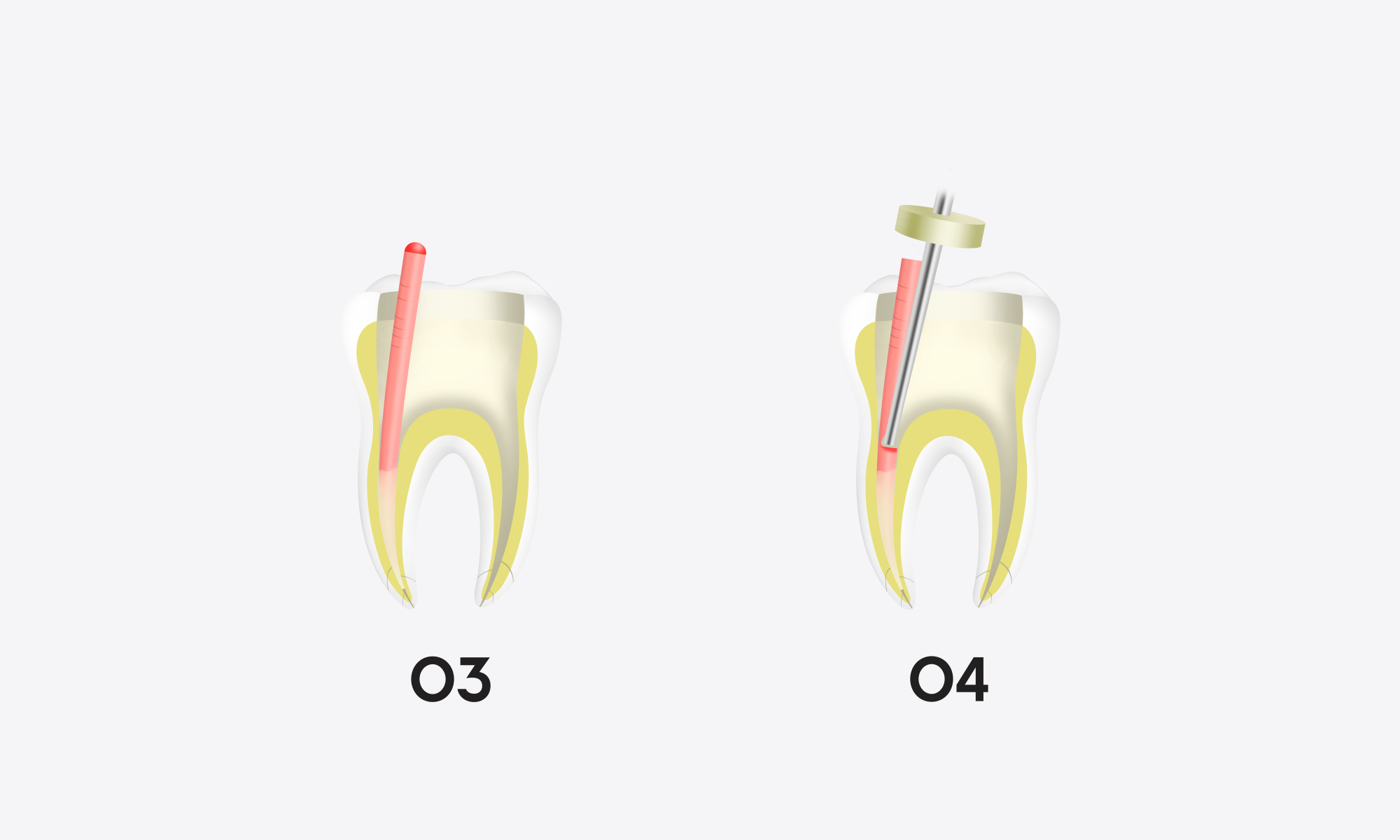 Minimax-Implant-Obturation-System-Woodpecker-Fi-G-Fi-P-09.webp