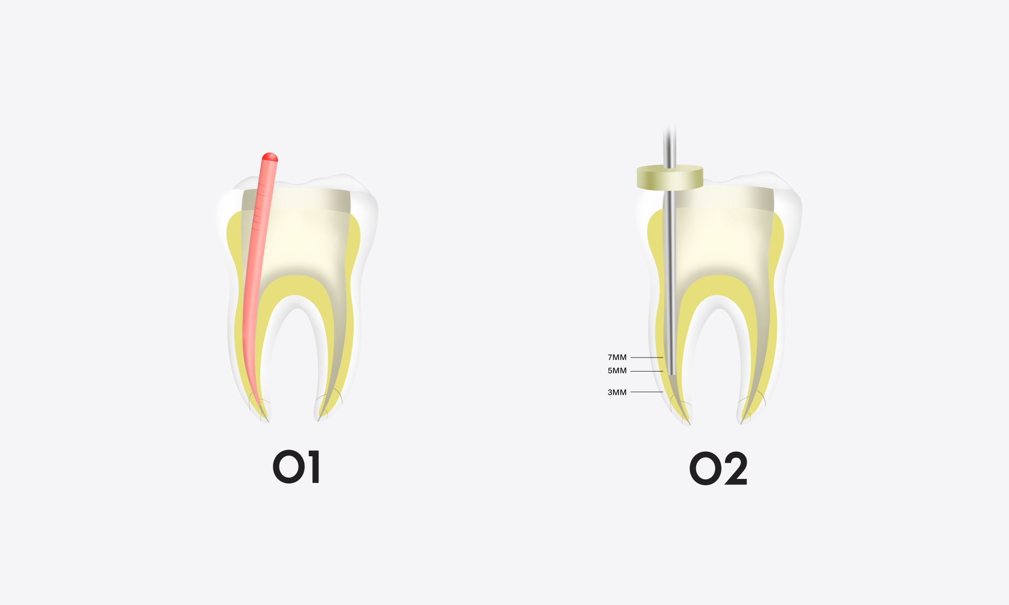 Minimax-Implant-Obturation-System-Woodpecker-Fi-G-Fi-P-10.webp