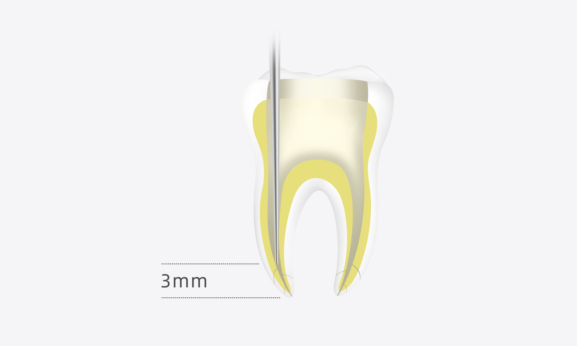 Minimax-Implant-Obturation-System-Woodpecker-Fi-G-Fi-P-12.webp