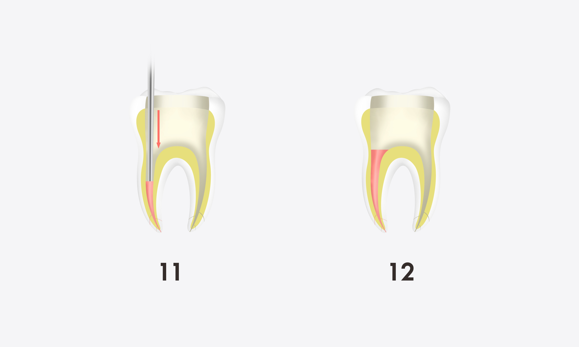 Minimax-Implant-Obturation-System-Woodpecker-Fi-G-Fi-P-13.webp