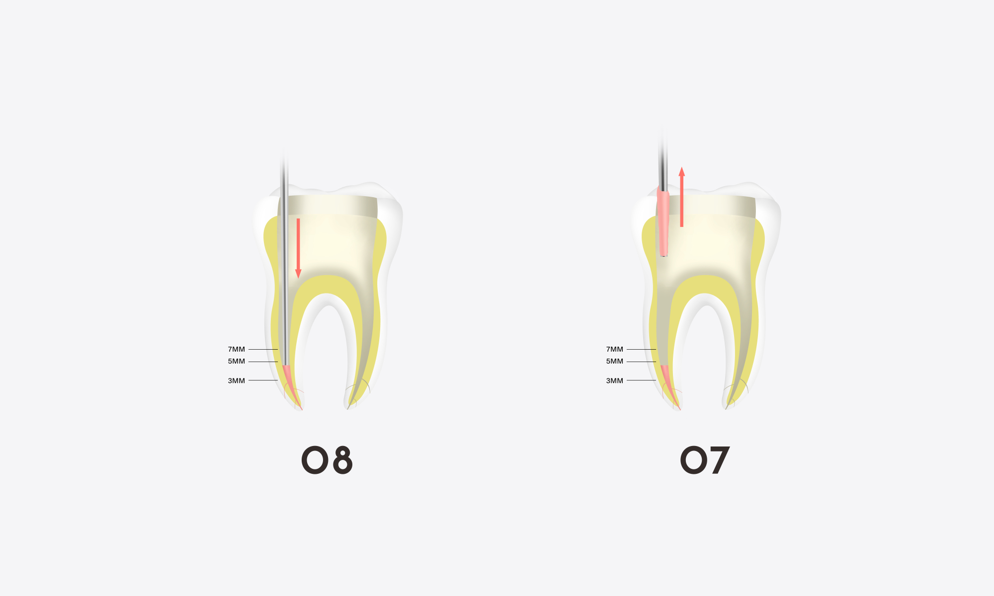 Minimax-Implant-Obturation-System-Woodpecker-Fi-G-Fi-P-15.webp