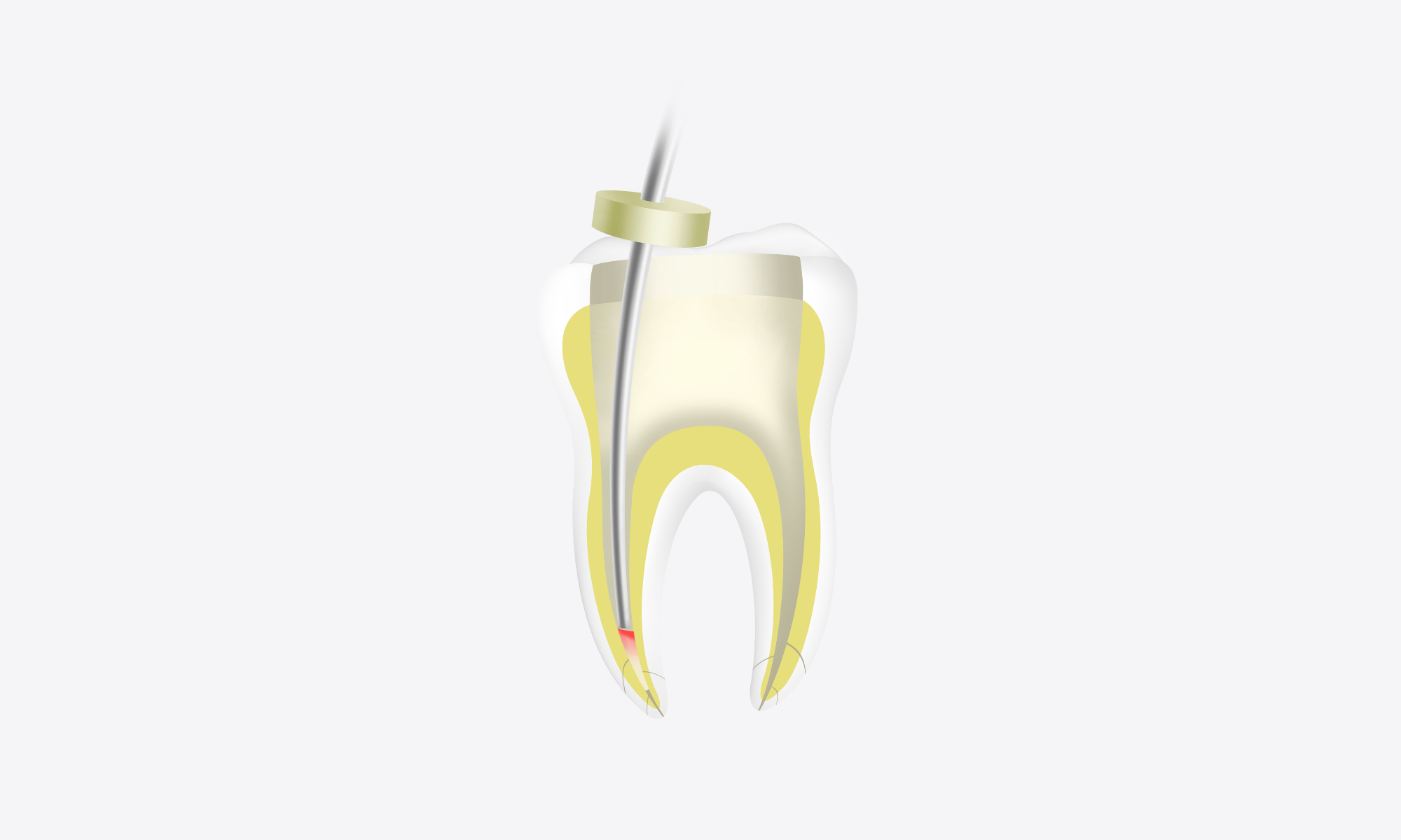 Minimax-Implant-Obturation-System-Woodpecker-Fi-G-Fi-P-16.webp