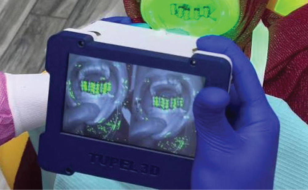 Tupel-3D-Intraoral-Scanner-Minimax-Implant-08.webp
